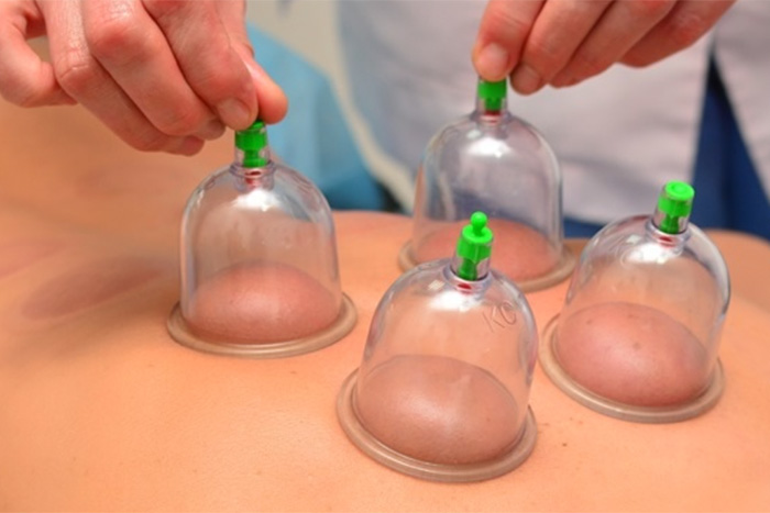male-cupping-img Dry Cupping